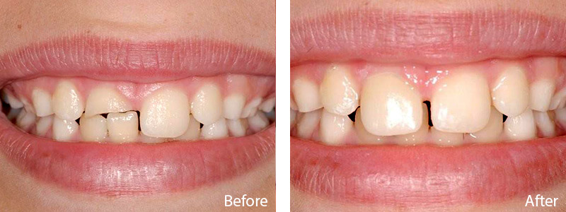 Dr.Schulz fixed his smile using a CEREC restoration in a single visit.