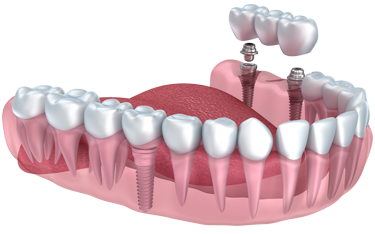 Missing teeth can be replaced with dental implants, bridges or dentures. Dr. Schulz will help you choose the option that’s best for the health of your teeth and your budget.